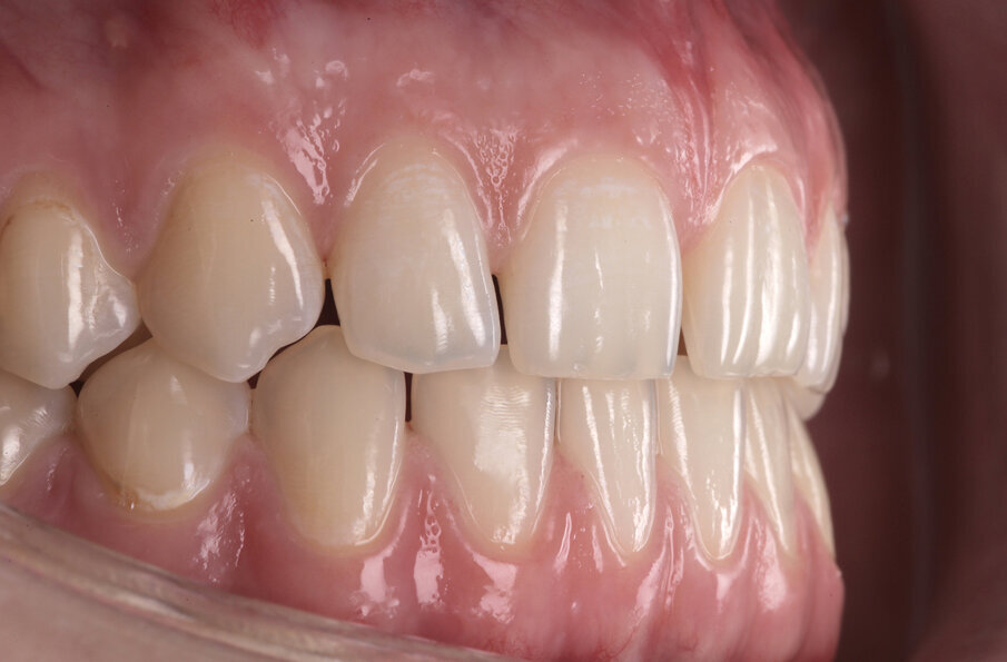 Fig. 2: This is the natural structure of the teeth we wanted to adapt in the final restorations.
