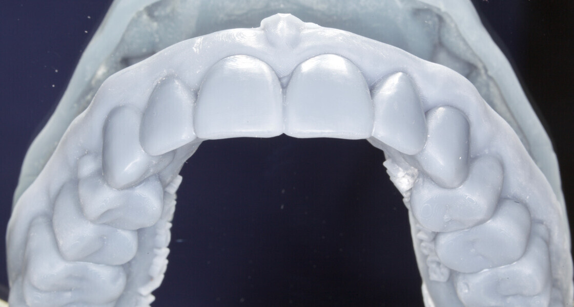 Fig. 5: 3D-printed model of the upper jaw with the virtually designed wax-up.