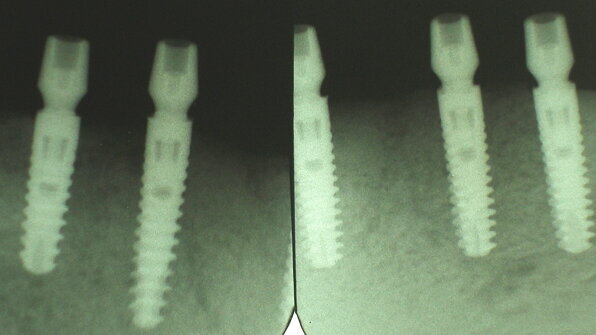The Ankylos-SynCone Overdenture System: The biology, diagnosis and treatment