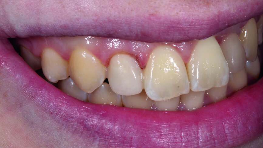 Fig. 13: Crown lengthening was performed on tooth #12.