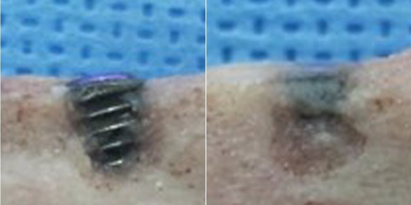 Side-by-side comparison of the efficacy of SOI surface technology in terms of clotting and osseointegration.