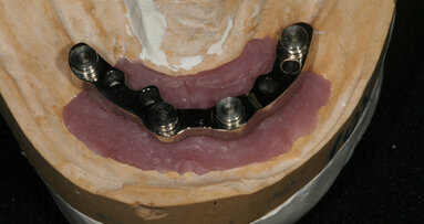 Barre fresate per overdenture: protocollo e procedure