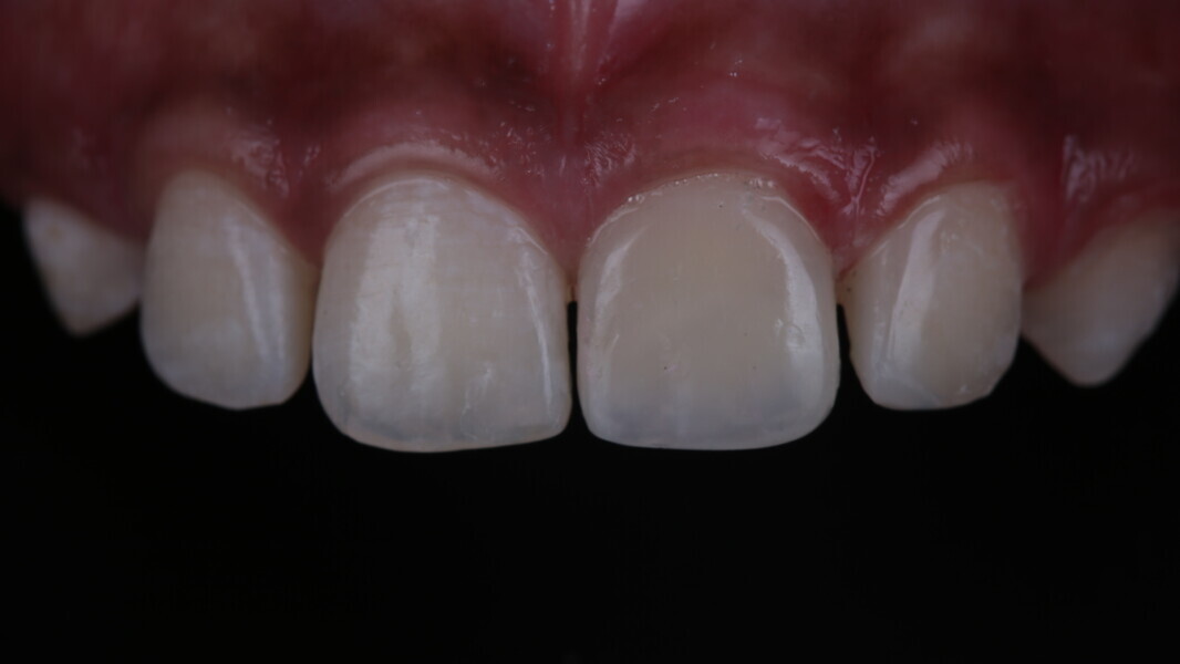 Fig 39: Final composite resin restoration immediately after the polishing procedure.