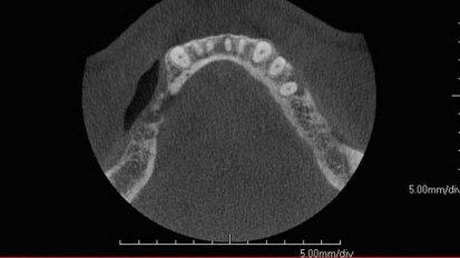 Edentulous patients can benefit from the integration of CBCT data