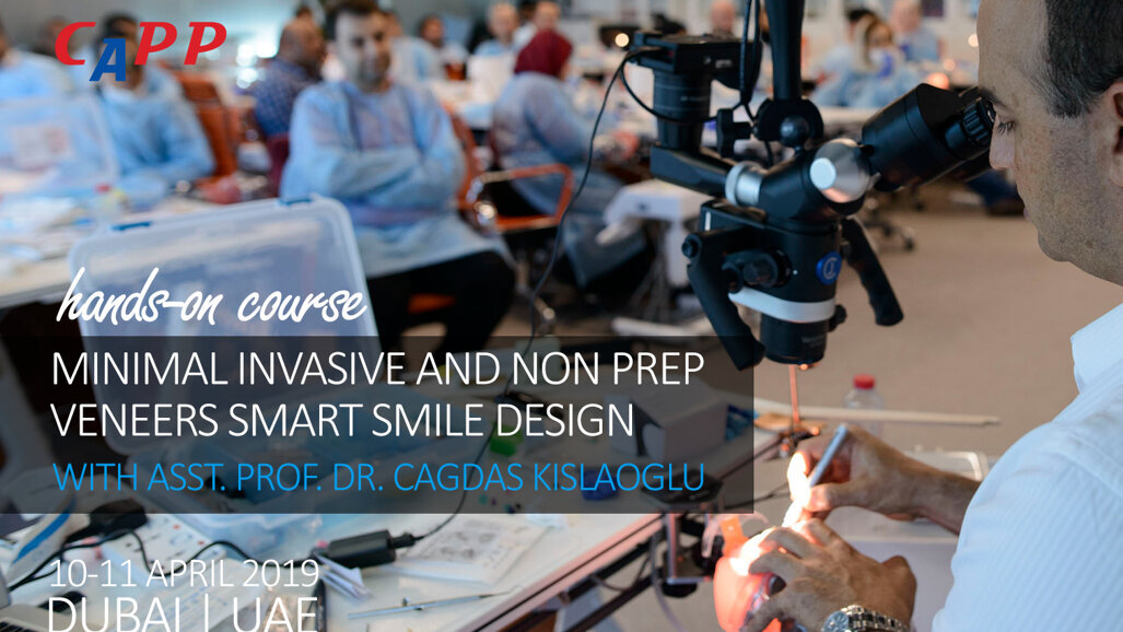 Minimal Invasive and Non Prep Veneers Smart Smile Design with Veneers
