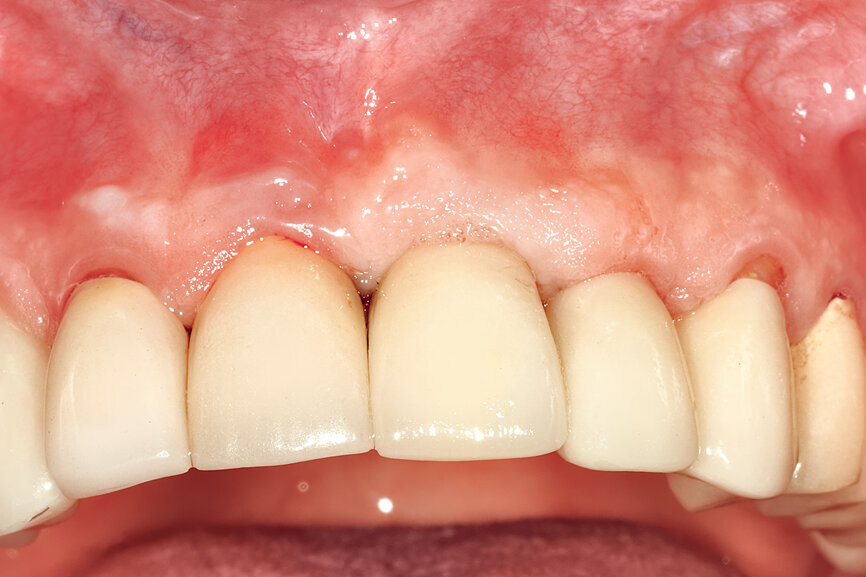 Fig. 29: The definitive restoration exhibited excellent retention of the soft-tissue profile.