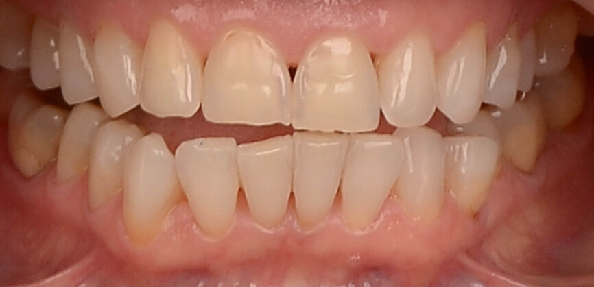 Fig. 1: The patient had worn teeth, visible abrasion, erosion and crowding in the mandibular arch. 