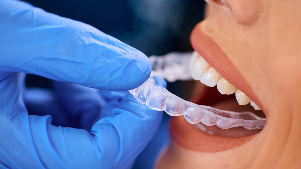 Danish study examines aligner treatment in general dental and orthodontic practice