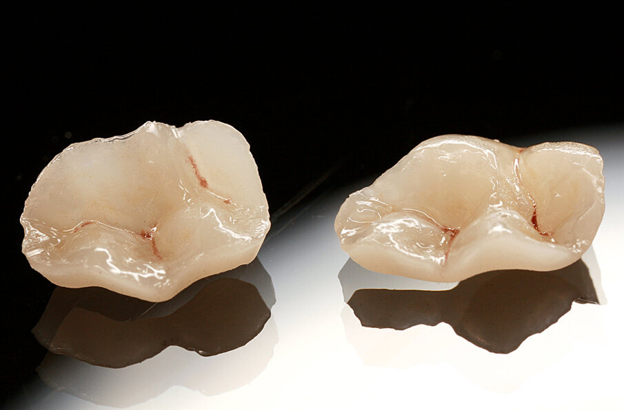Fig. 13: The cavities were restored with IPS e.max CAD HT restorations produced at chairside.
