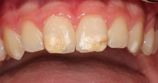 The anterior teeth are often affected as well. The discoloration and abrasion of the surface have an evident aesthetic impact, with consequent psychological effects for the child. (Photograph: Prof. Norbert Krämer)