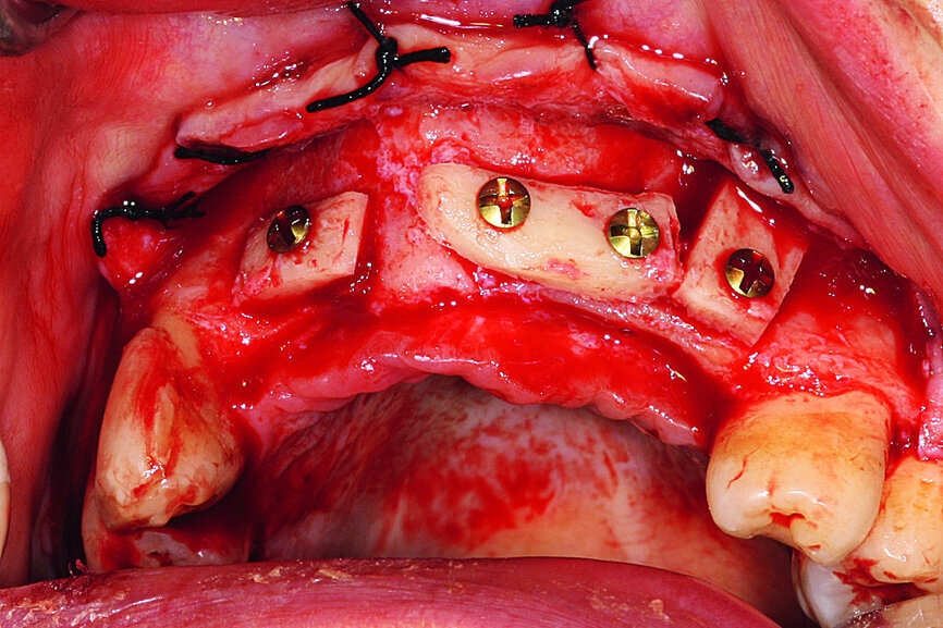 Fig. 7: The grafts were harvested from the chin symphysis and firmly attached by surgical screws in the recipient site.