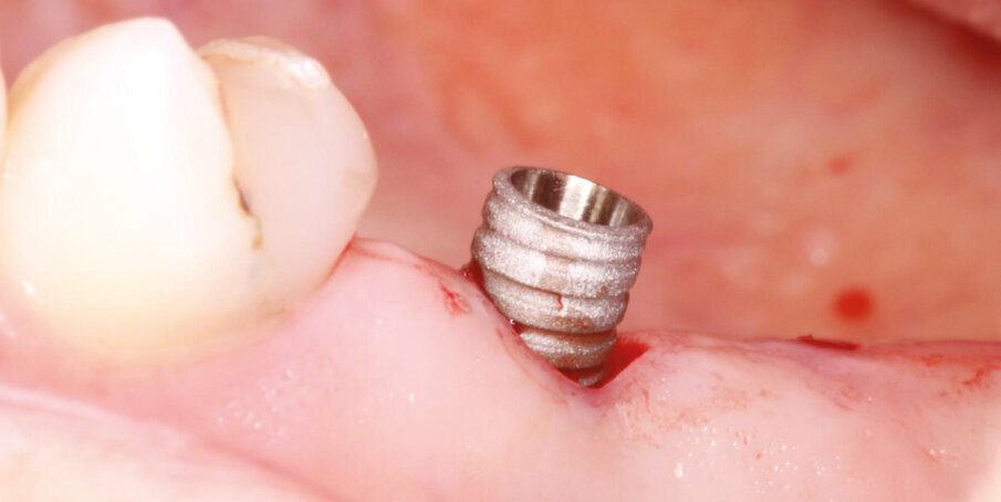 Fig.9: Axiom REG placement flapless in #15,16 (4,0x10 ; 4,0x8 mm). 