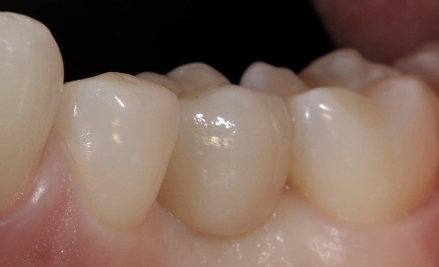 Fig. 16_Lo strato superiore realizzato in Vita Trilux Forte (dx).
