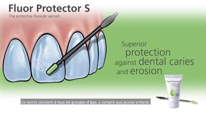 Ivoclar – Application du vernis Fluor Protector S