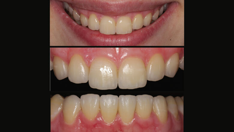 Figure 11: Try-in of the restoration after the stains firing cycle