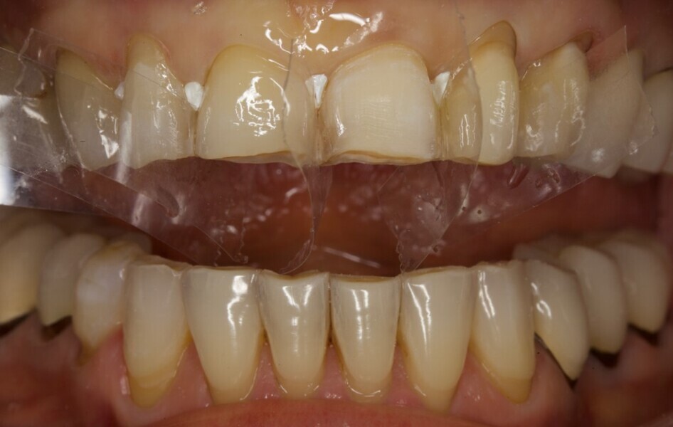 Fig. 10: Etched and bonded surfaces of the right canine, right central incisor and left lateral incisor after isolation with clear matrix strips.