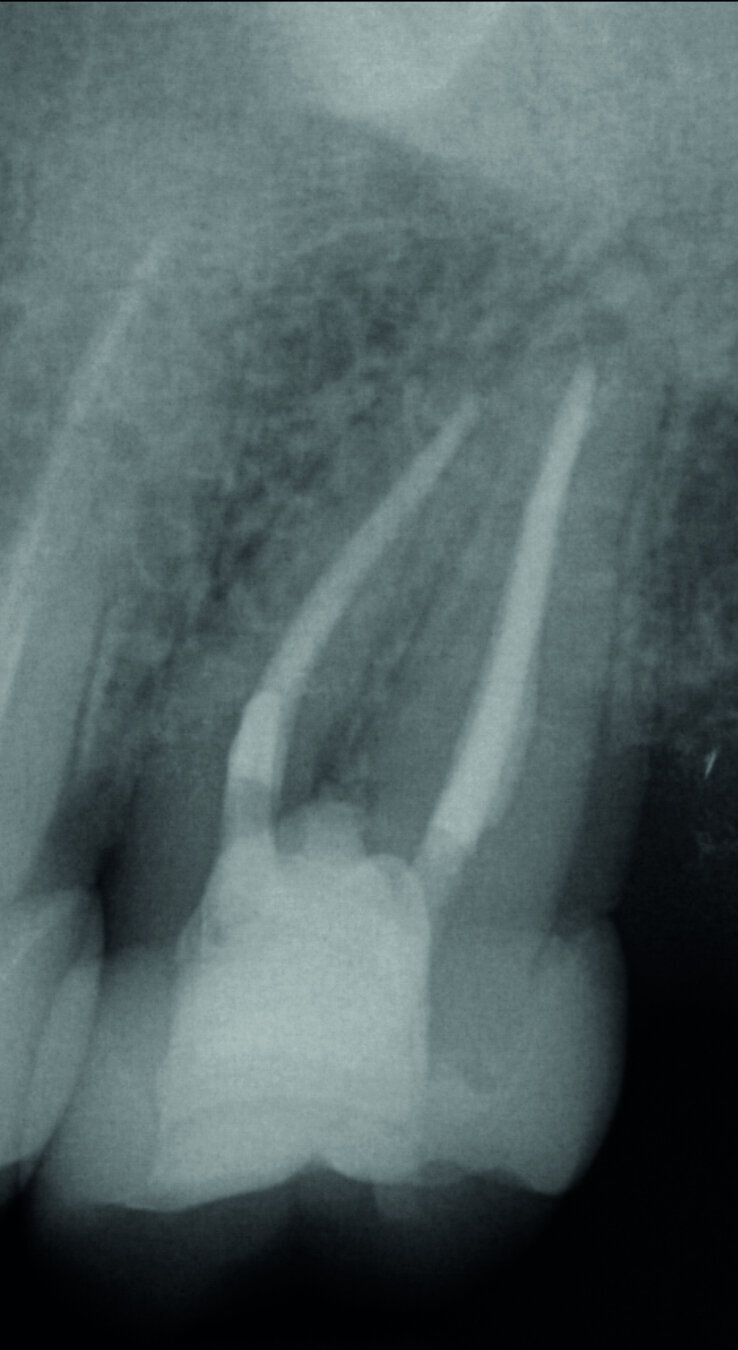 Fig. 18 : Examen radiographique final.