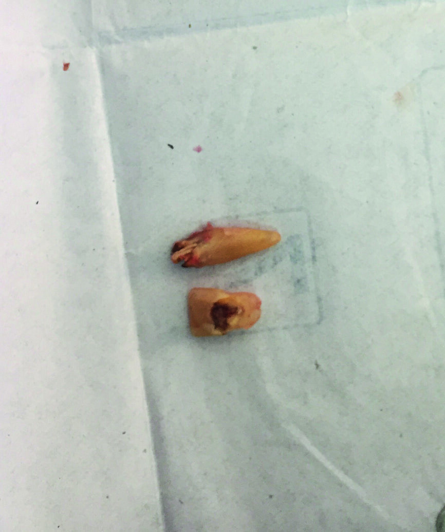Fig. 2 : Dent 21 après extraction.