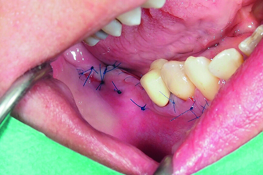 Fig. 20: Wound closure with monofilament sutures.