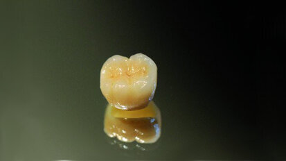 Intra-oral scanning with 3M True Definition Scanner, realisation with CARES
