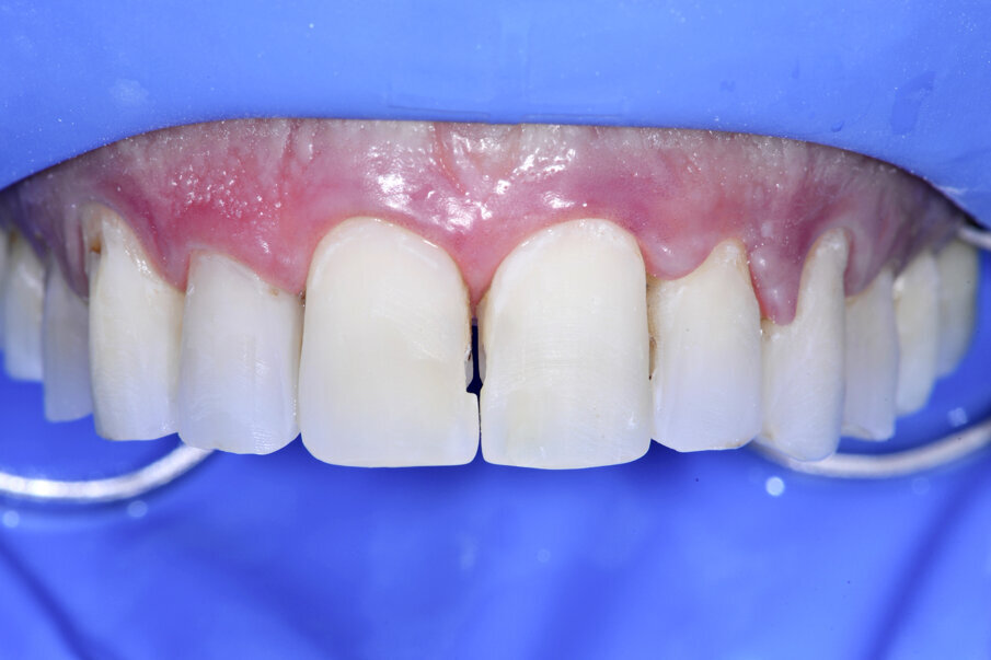 Fig. 20: Current preparation, not more invasive than 9 years ago