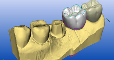 Safety-first implant therapy