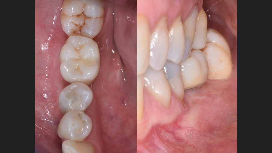 Fig. 8 - Inserimento di una corona in zirconio monolitico avvitata su impianto. Si osserva un ottimo mantenimento volumetrico dei tessuti molli.