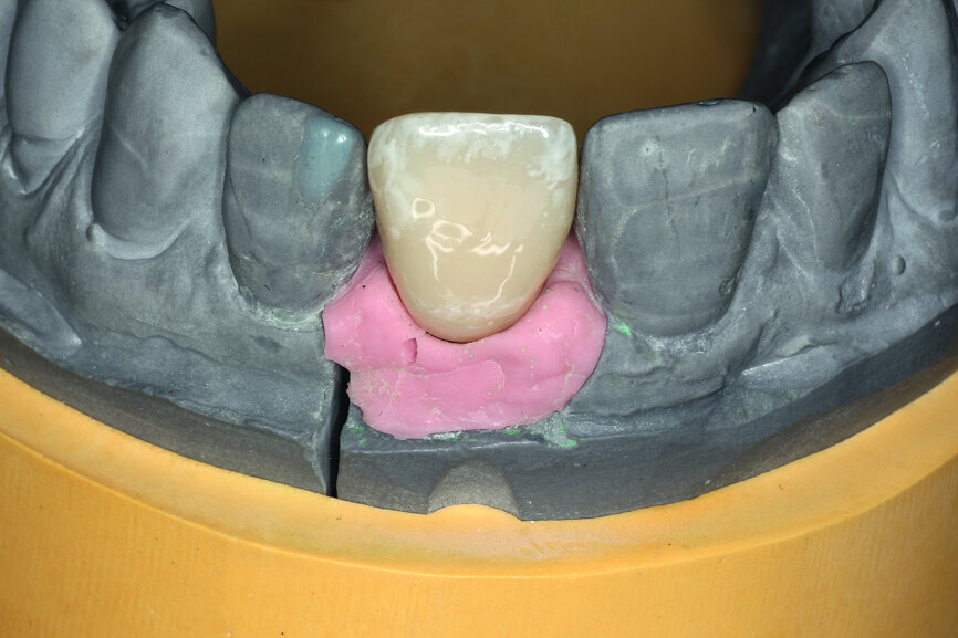 Fig. 8b: A PEEK abutment as the base for the long-term temporary restoration.