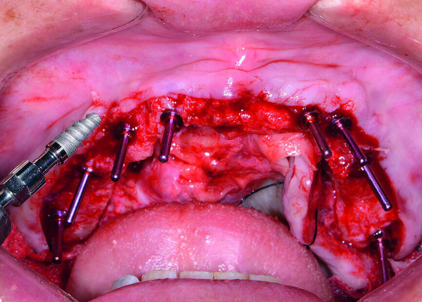 Fig 11 Insertion d’un implant dentaire Hahn