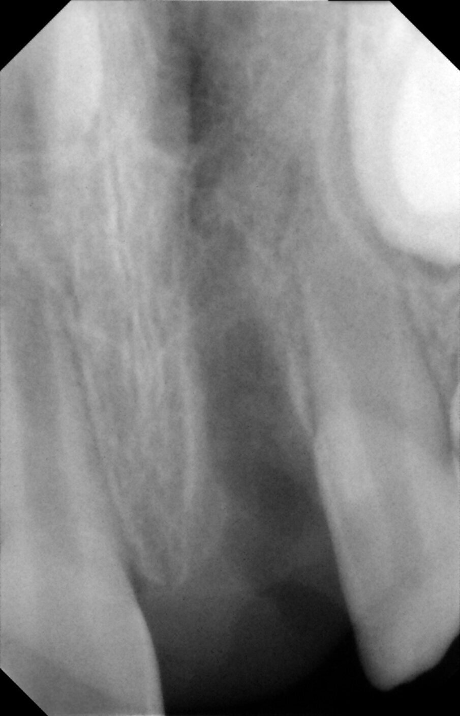Figures 4b.  Empy socket of 21 due to its avulsion. Notice the immature apices of 12, 11 and 22. In addition there was a supernumerary tooth/mesiodens