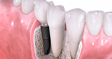 Implantatinnovation aus Mexiko