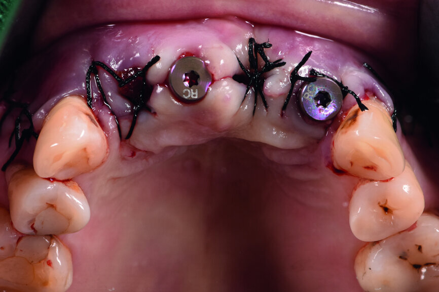 Fig. 6: Occlusal view of the anterior teeth immediately post-op.