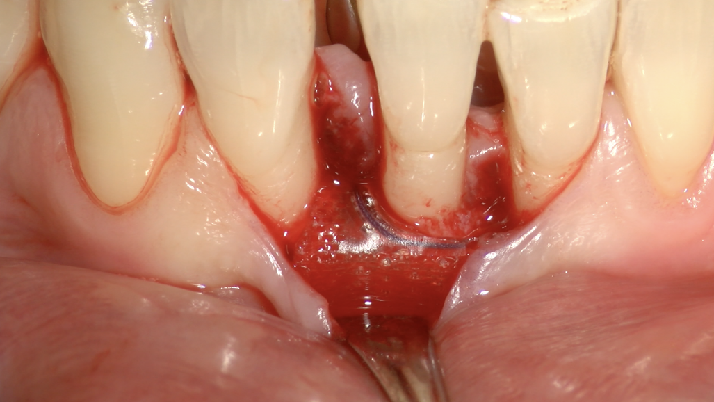 Rigenerazione Parodontale con membrana GUIDOR matrix barrier: difetti intraossei e forcazioni