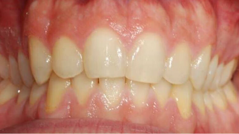 Valutazione clinica dello sbiancamento combinato post Invisalign: case report