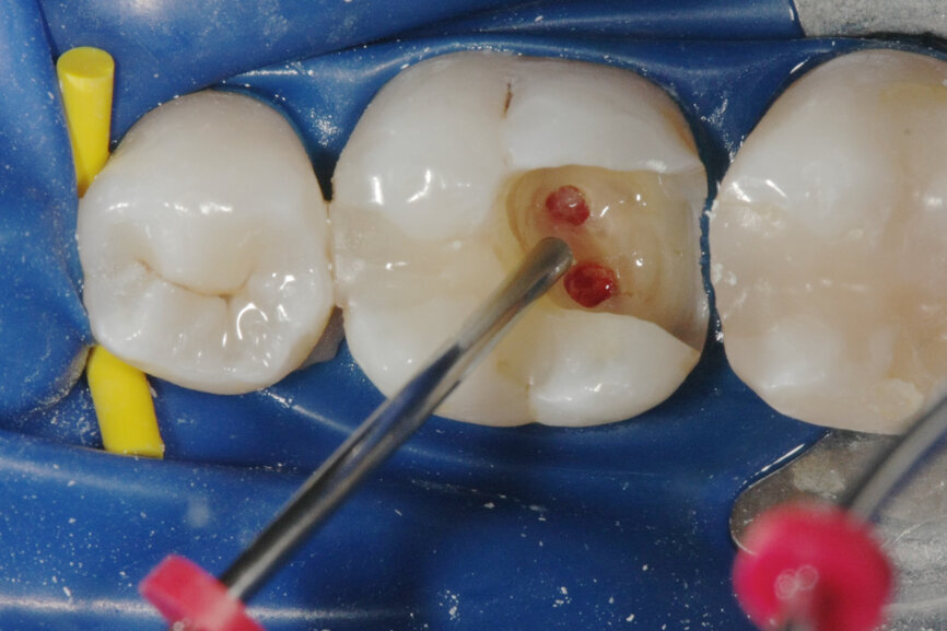 Fig. 1b: (a) Deep carious lesion. (b) Partial pulpotomy. (c) MTA application with the MAP System and PD MTA White. (d) Filling. (e) Post-op radiograph showing the pulp capping with MTA.