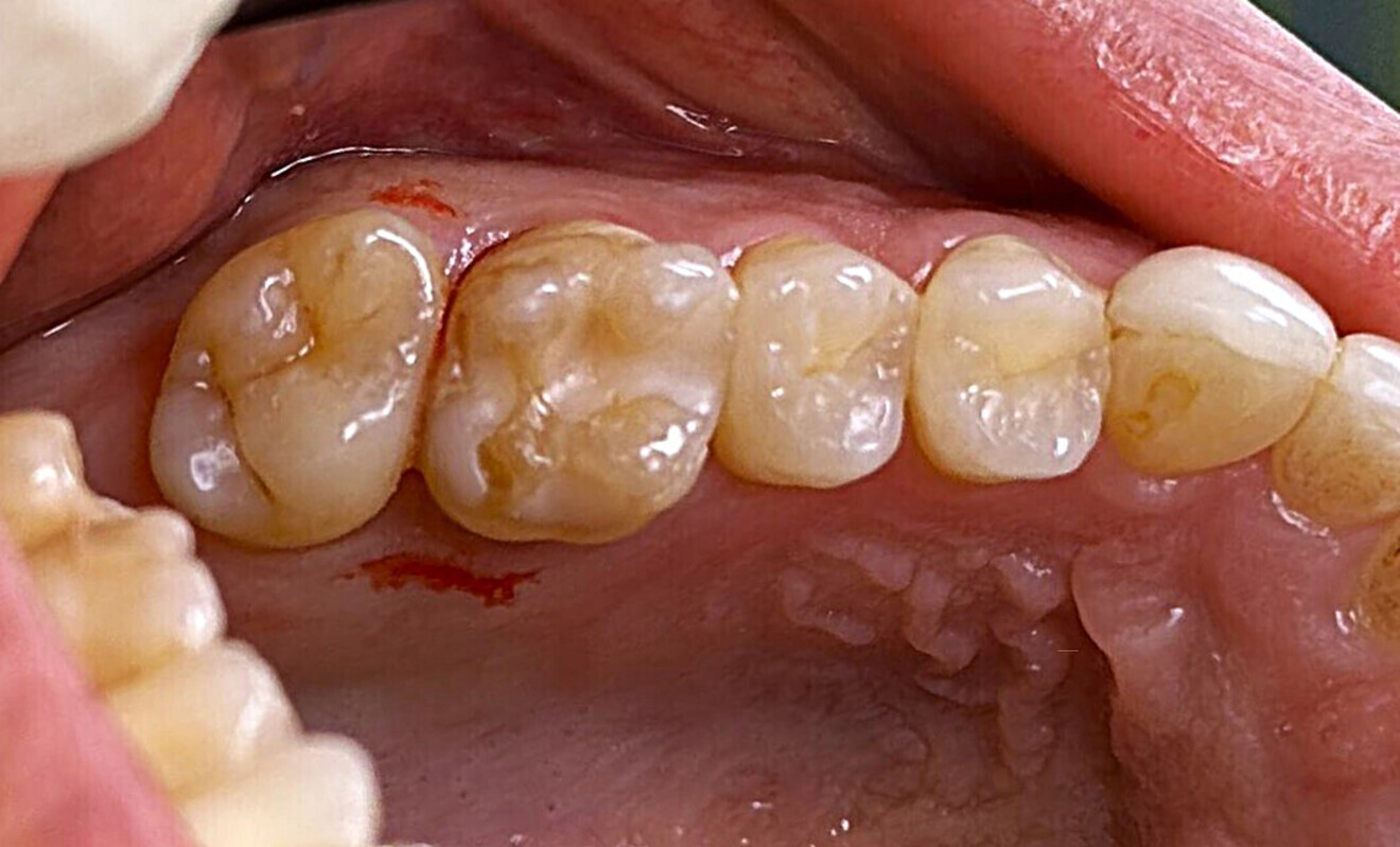 Fig. 4: Clinical view of the occlusal surface of the maxillary right first molar showing the composite present.