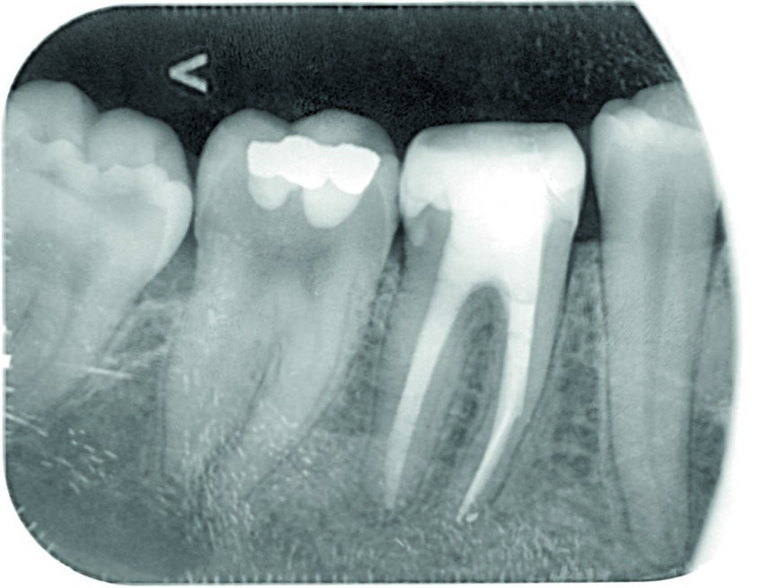 Fig. 7: Control radiograph after three months