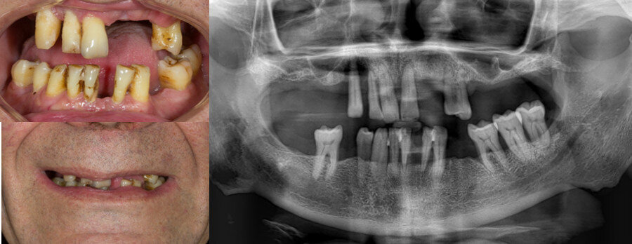 Figs. 2a–c: Pre-op evaluation: dental occlusion (a); dental panoramic tomograph (b); and appearance of the contour of the lips and orbicularis oris muscle of the mouth (c).