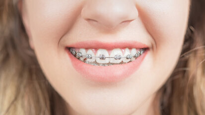 Neuer Kleber für Brackets soll vor Kariesbildung schützen