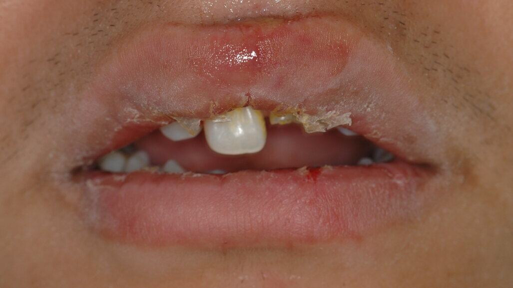 Reconstrucción inmediata de dientes con destrucción avanzada