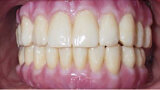 Fig. 28. Rx Pre-operatoria, Prótesis híbrida inmediata con 5 años de evolucion y Rx Control a los 5 años.