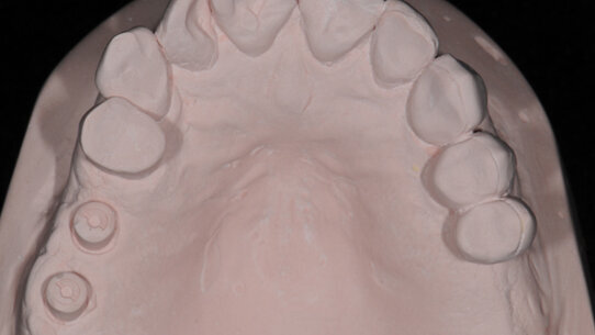La rivoluzione delle impronte su impianti Encode® restorative system