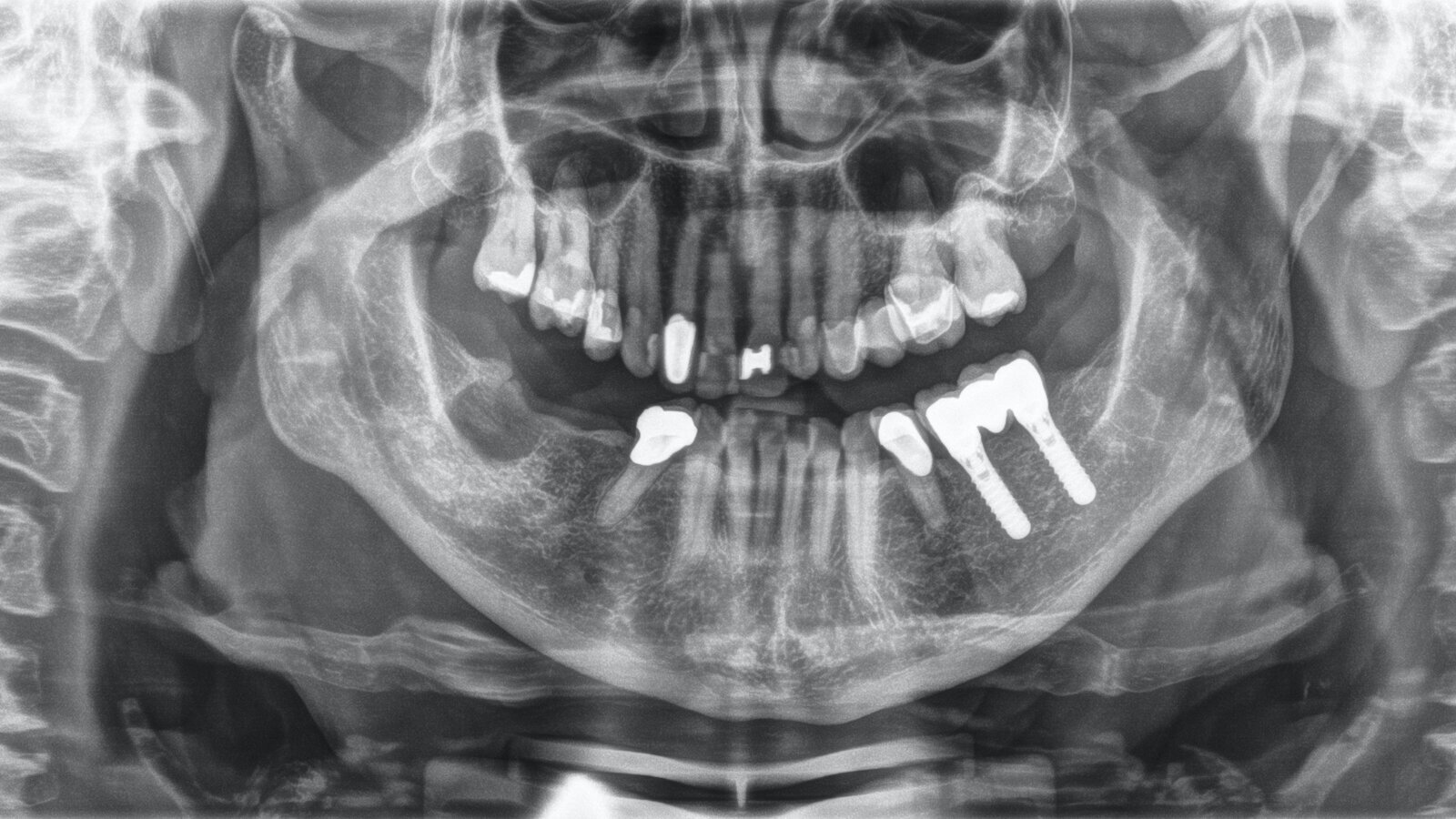 Tratamiento preventivo en paciente sana con enfermedad periodontal