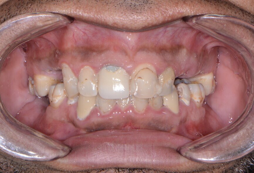 Fig. 1: Pre-op retracted frontal view.