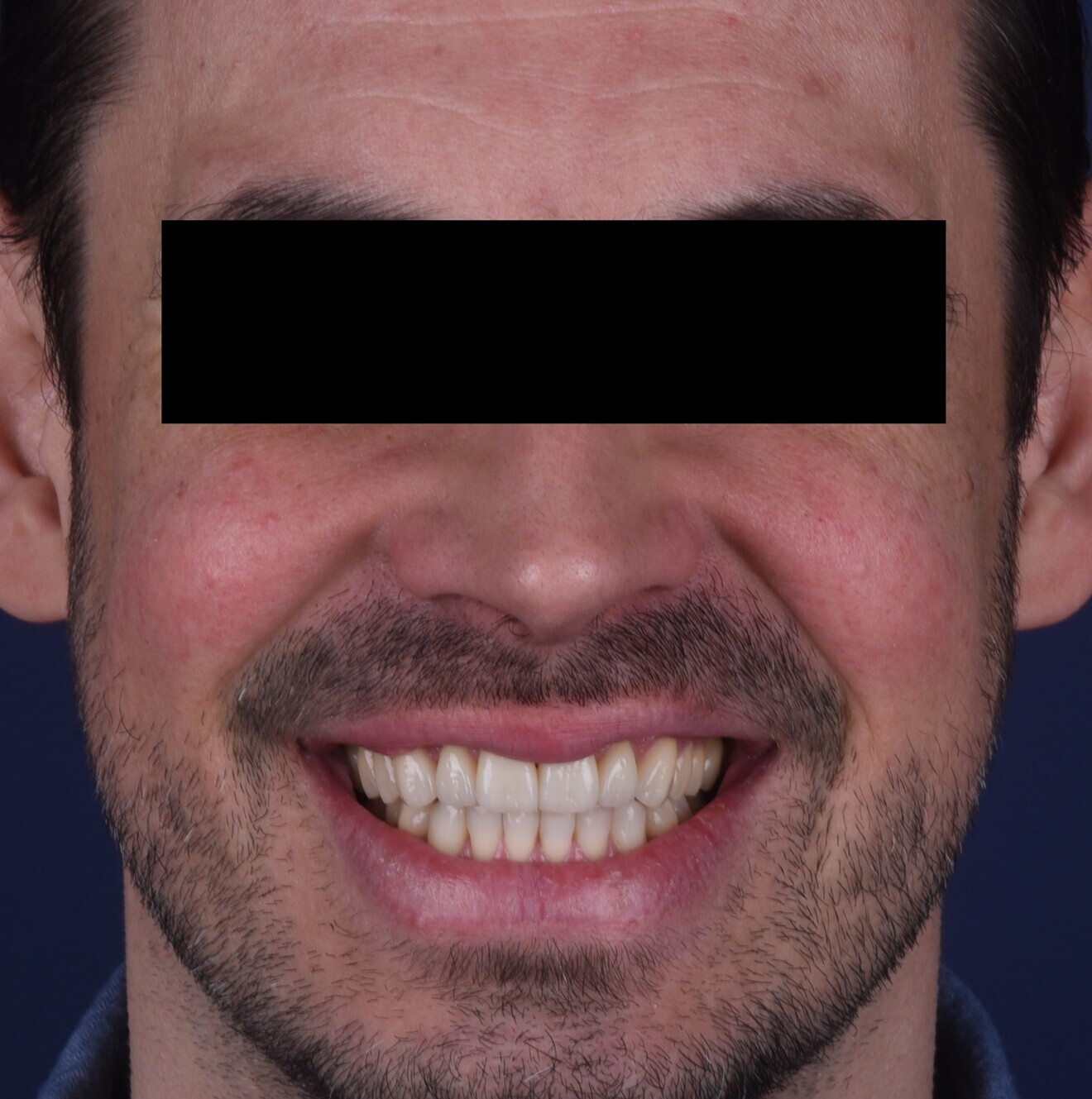 Fig. 16a: Final extra-oral photograph.