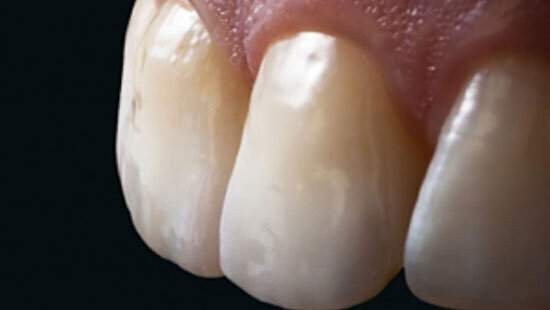 Fig. 13. La morfología y la textura superficial de ambas restauraciones de cerámica sin metal ya no se distinguían de los dientes adyacentes naturales.