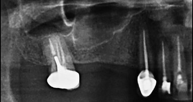 Elevace čelistní dutiny pomocí krátkého implantátu
