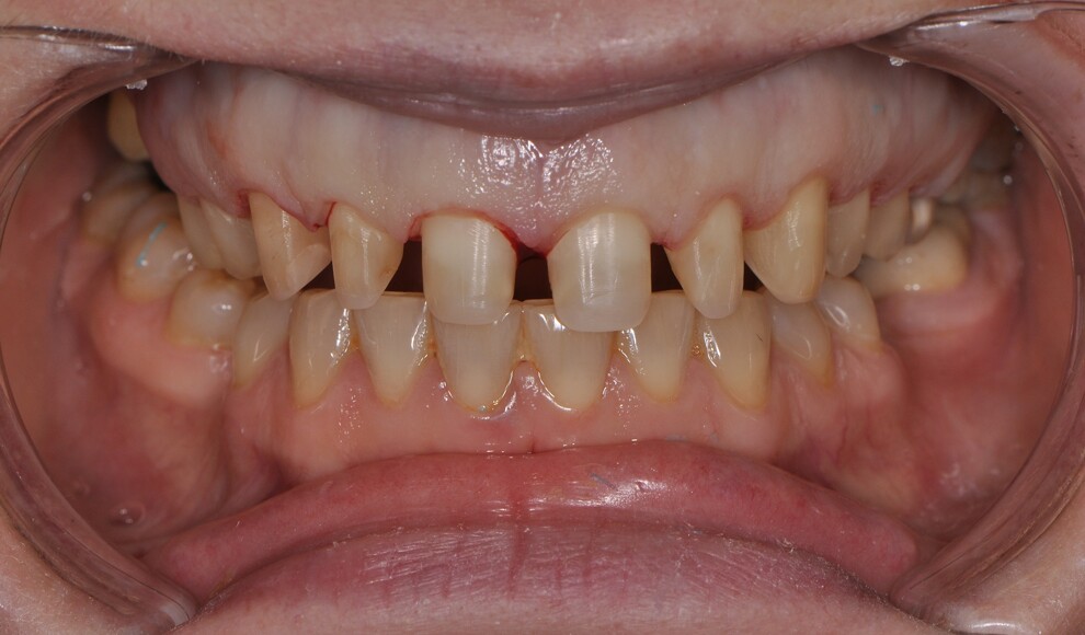 Fig. 4: Minimally invasive tooth preparation of the maxillary anterior teeth prior to definitive restoration.