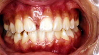 Dientes supernumerarios. Casos clínicos
