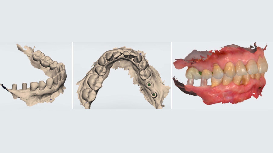 Fig. 11_Immagini della scansione 3D eseguita con scanner ottico per esecuzione del manufatto protesico provvisorio.